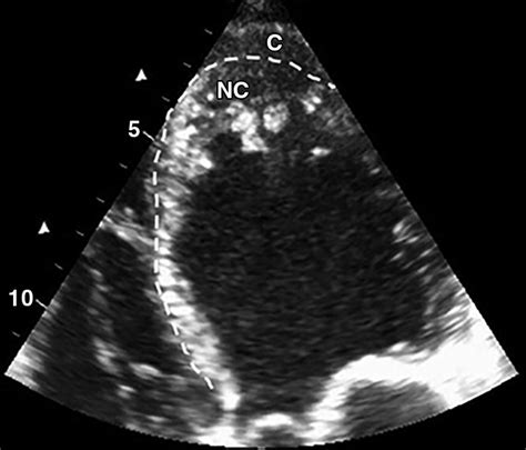 lv non compaction echo criteria|noncompaction cardiomyopathy mri.